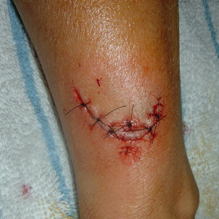 239 When can I run with stitches? DOC
