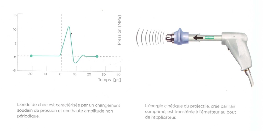 Ondes de chocs radiales Dr Yves ROUXEL