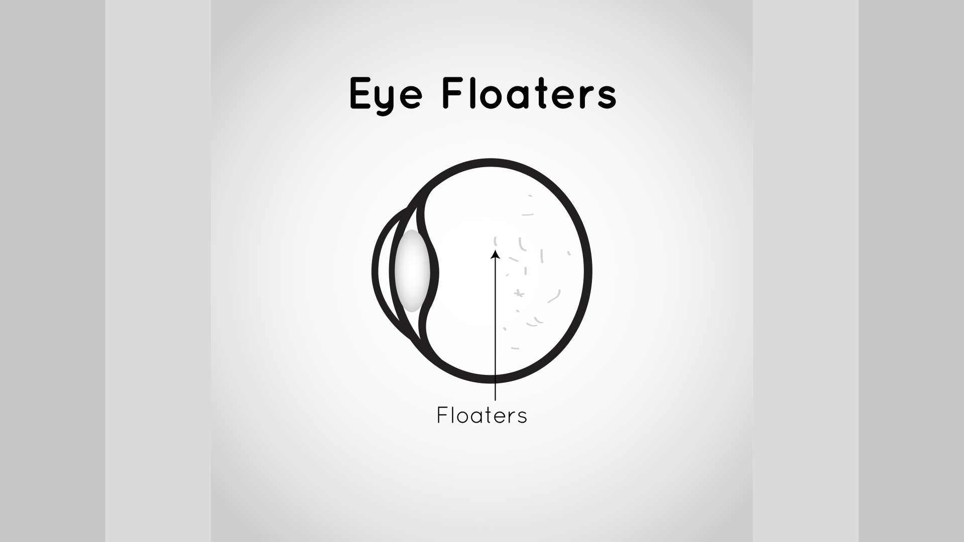 Homeopathic Treatment for Eye Floaters Treat the Root Cause Doctor