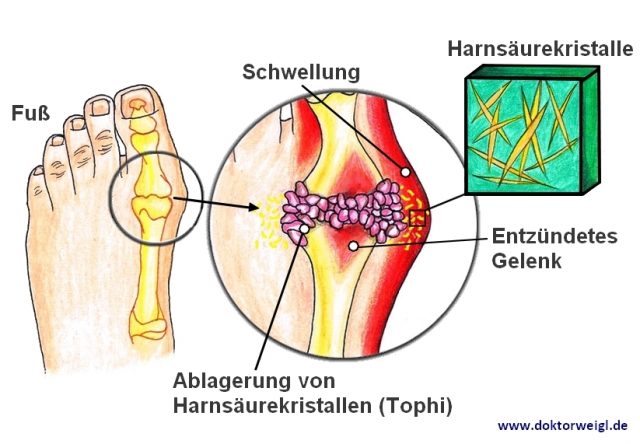 Gicht: Ursachen, Symptome, Behandlung NetDoktor.ch