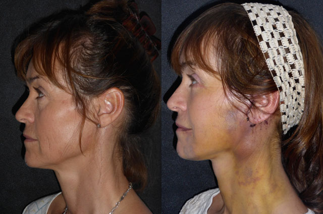 Debbie 53 Facelift Neck lift Lower eyelid surgery