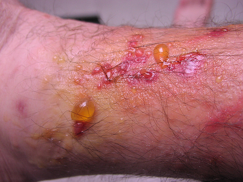 Poison Ivy And Its Relatives Medical Preparedness Doom and Bloom