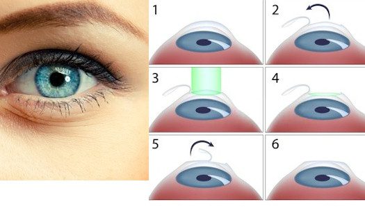 Benefits and Risks of Laser Eye Surgery Dot Com Women