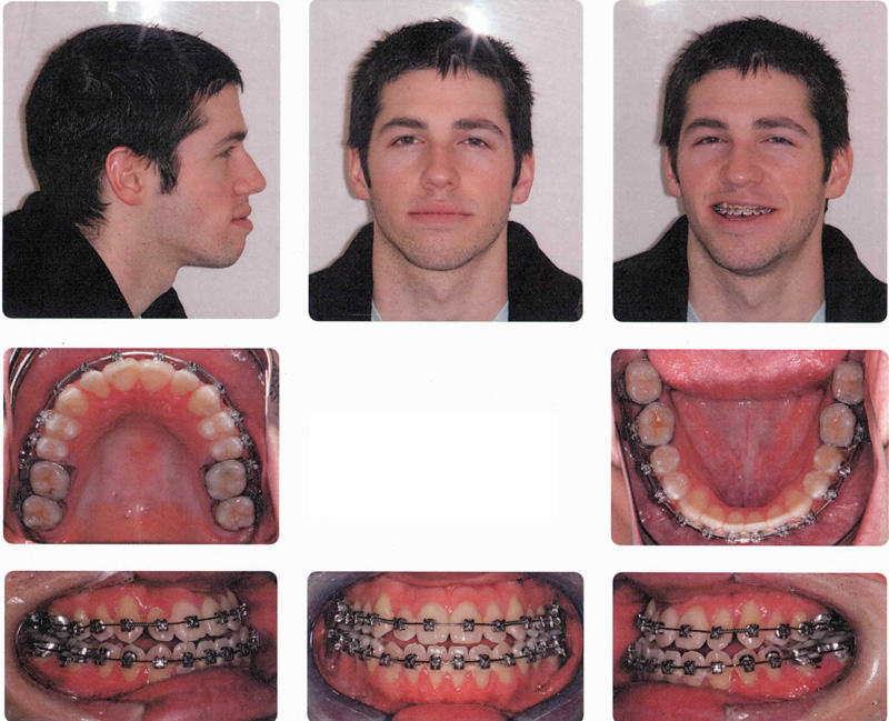 Before and After Photos Double Jaw Surgery