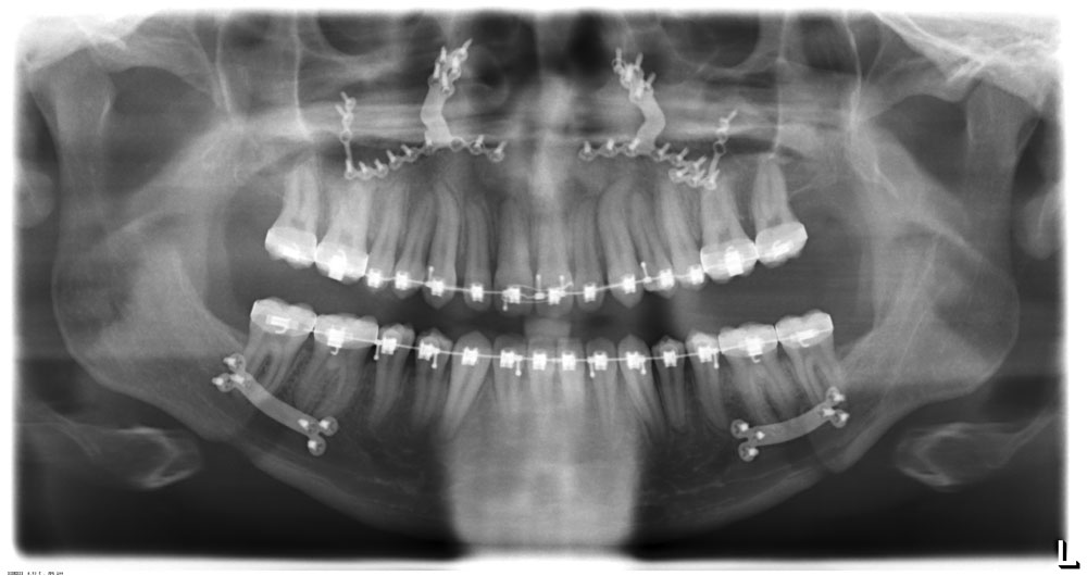 XRays Double Jaw Surgery