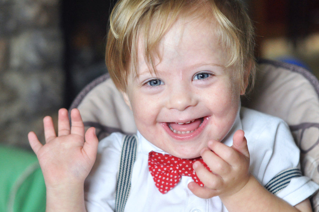 ¿Existen diferentes grados de síndrome de Down? Down syndrome