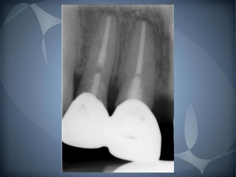 Post & Core for Anterior Crowns Prosthodontist Overland Park, KS