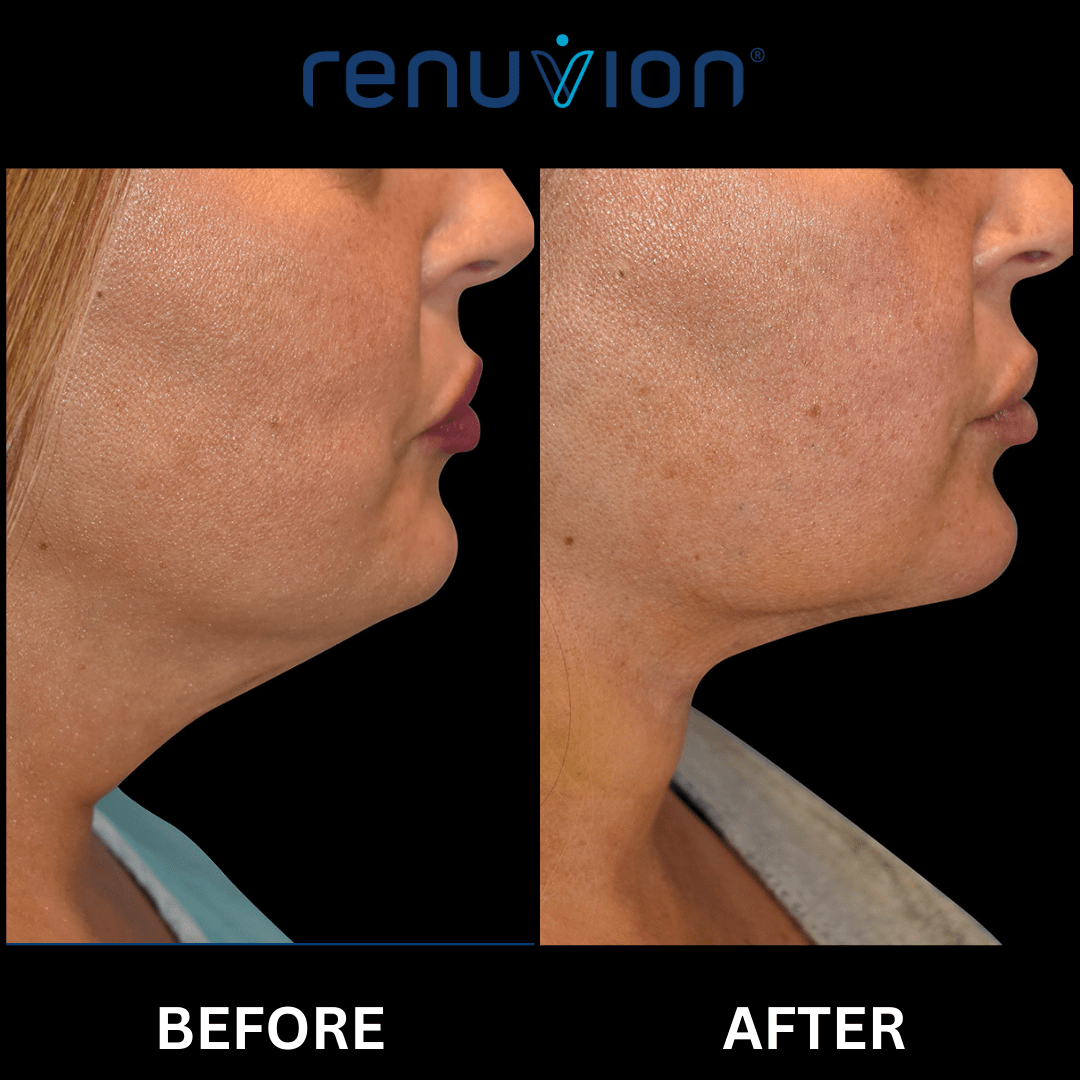 Renuvion® St. Petersburg, FL St. Petersburg Renuvion®