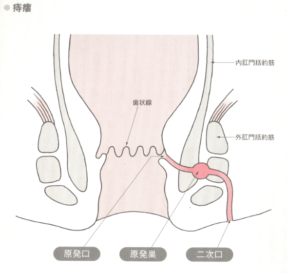 痔瘻の原因と発症の仕方 ｜痔の治療なら 東京青山 平田肛門科医院