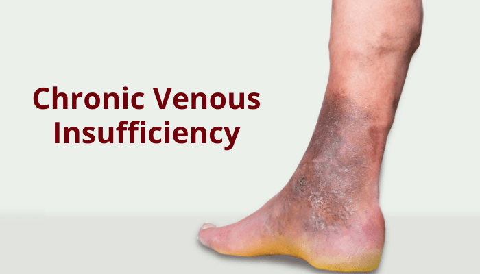 What is Chronic Venous Insufficiency? Dr Abhilash