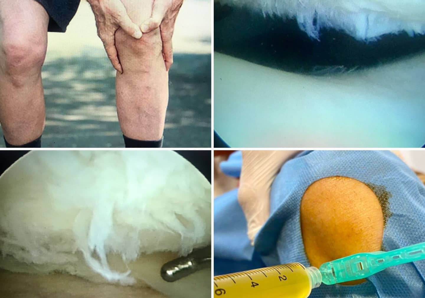 ¿Conoces los beneficios de las Infiltraciones de Plasma Rico en