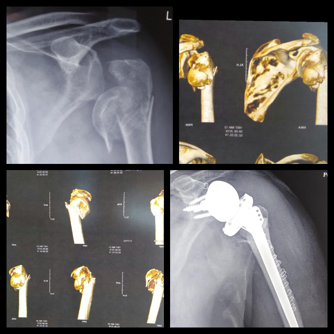 Dr. Amyn Rajani Performs Reverse Shoulder Arthroplasty for Proximal