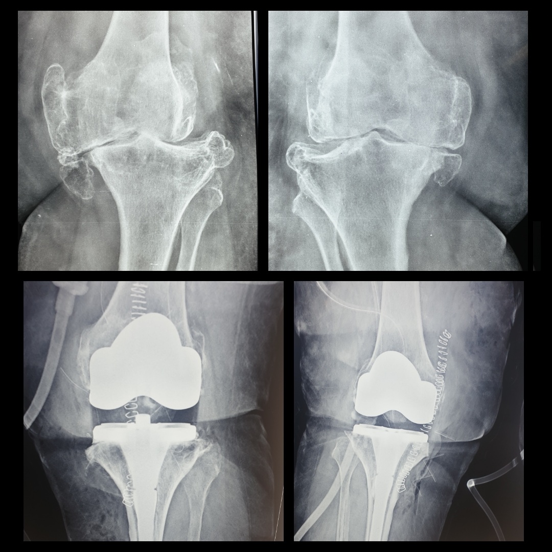 SingleStage Bilateral Total Knee Replacement Surgery Success Knee