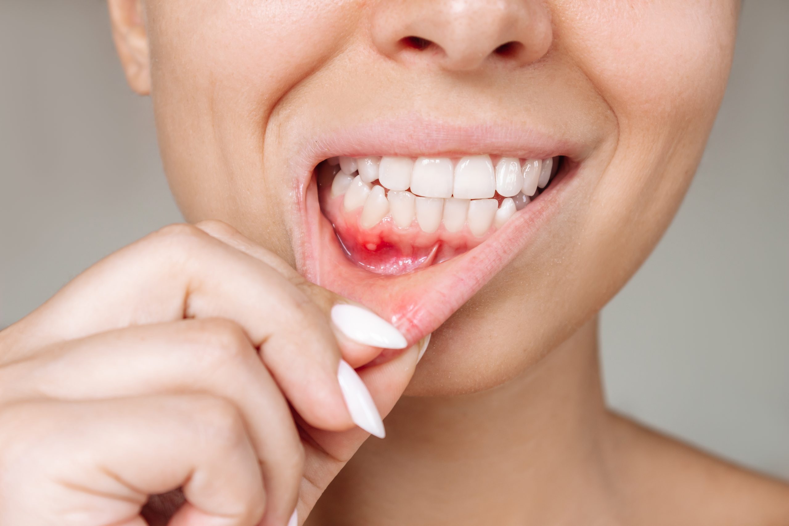 Gum Disease Stages Occurance Symptoms Treatments(04)