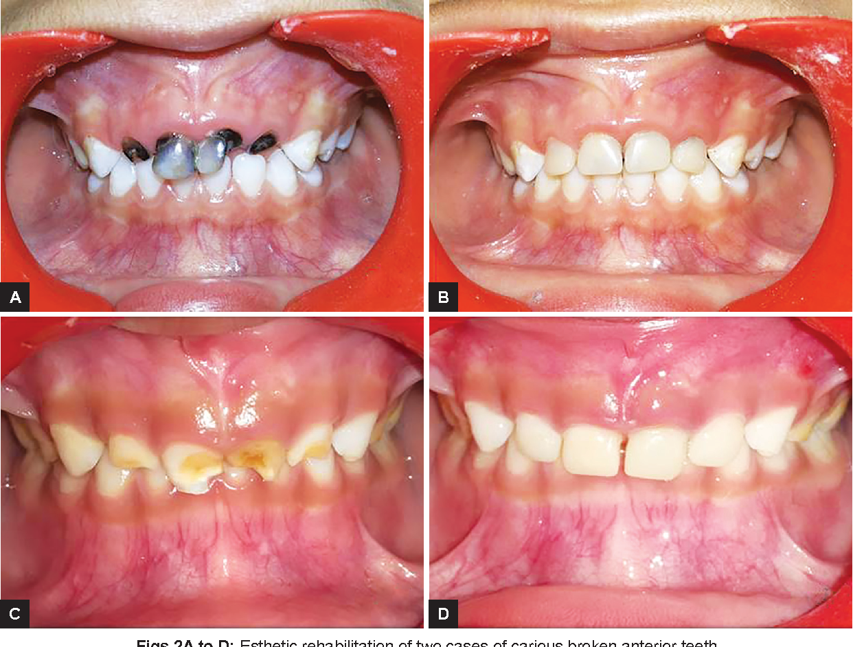 Treatment of Decayed Front Teeth Dr. Ashish Shah