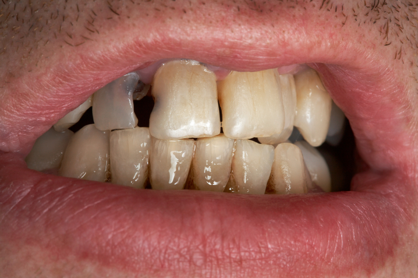 Cavities Part 2 Heavy Duty Dental Decay Dentist in Brampton, ON