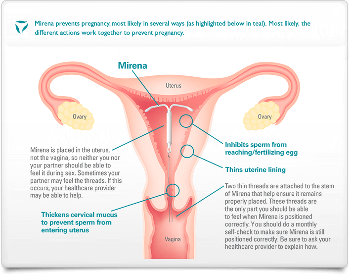 Bleeding While On Mirena 2025