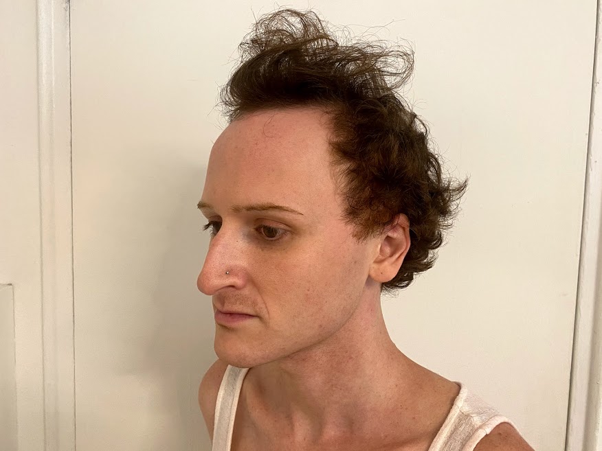Facial Feminization Surgery NYC (FFS) Nicholas Bastidas, MD