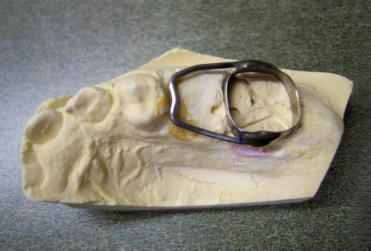 What are space maintainers and why might your child need one