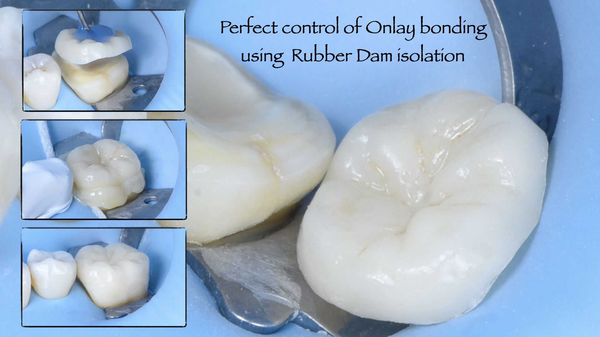 CERAMIC FILLINGS (ONLAYS) Dr. Calin Pop