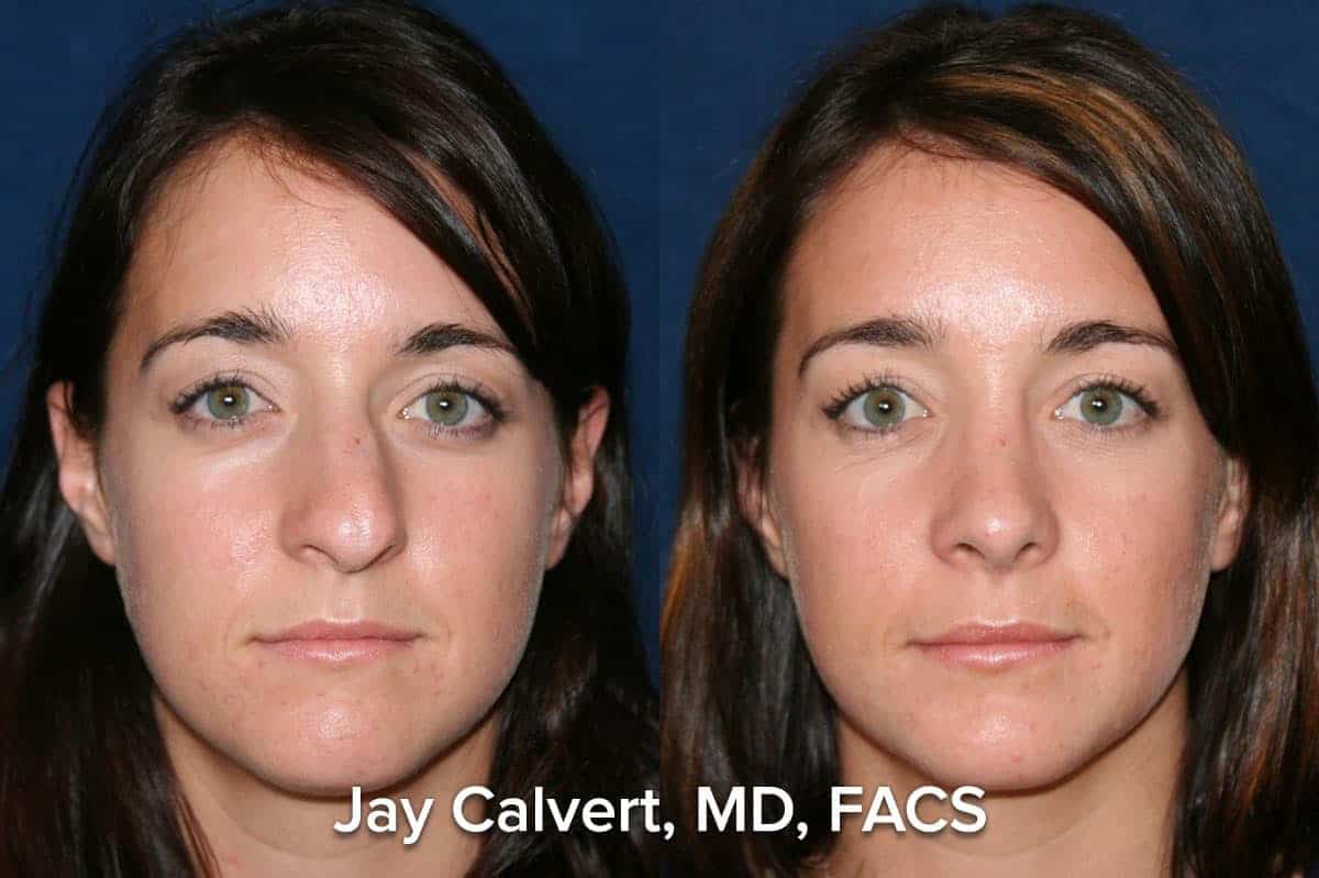 Best Rhinoplasty Surgeon in America Dr. Jay Calvert