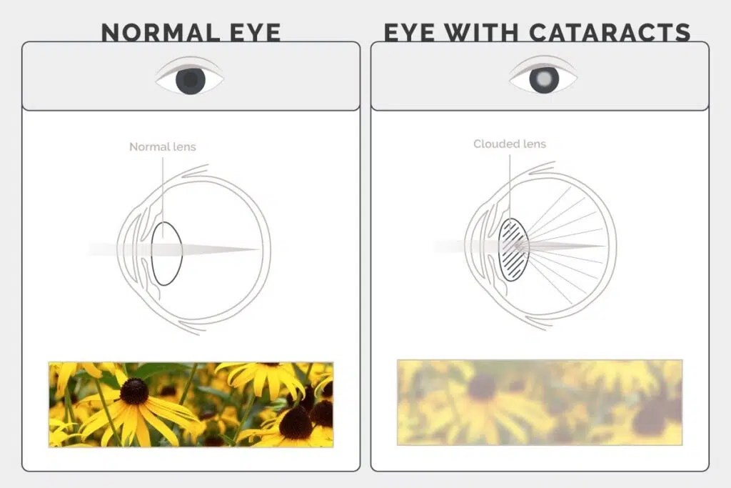 Laser Cataract Surgery vs Traditional Cataract Surgery Which is Better