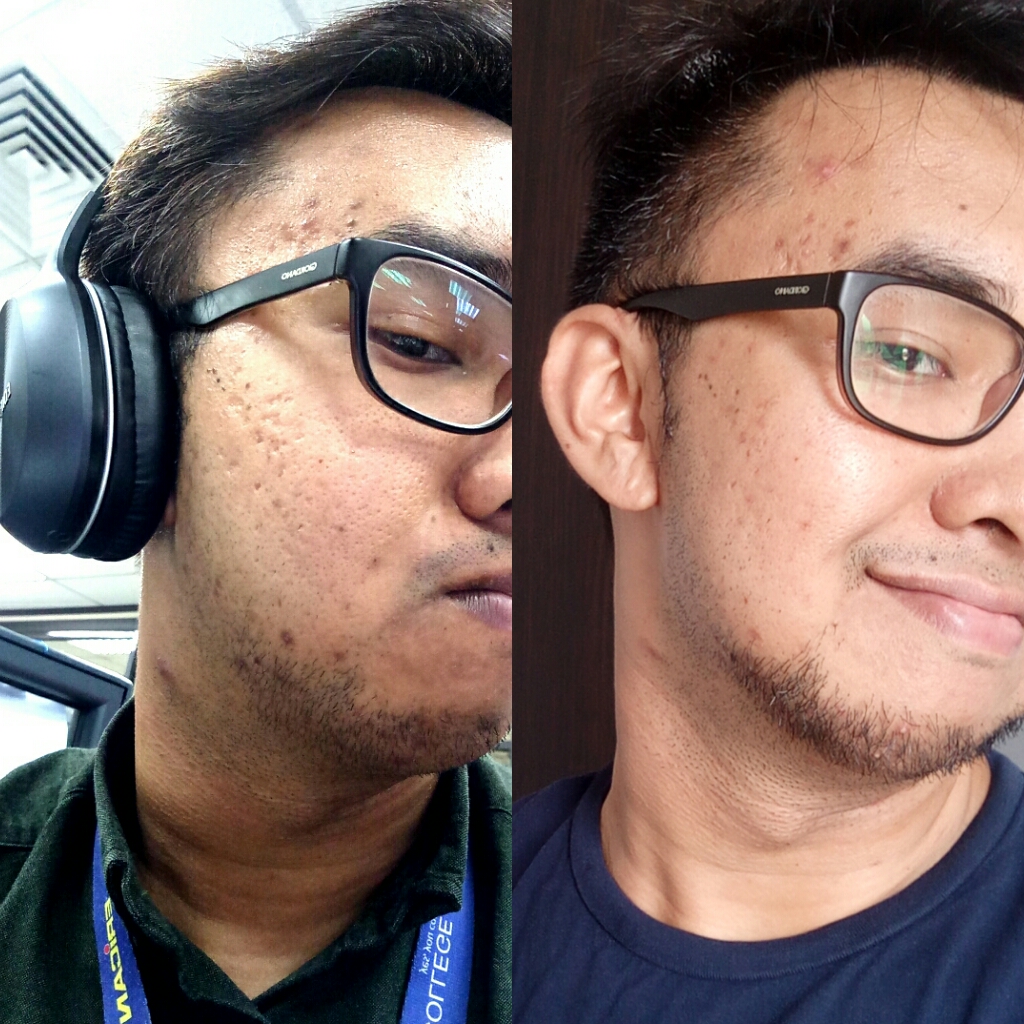 Premier Clinic Platelet Rich Plasma (PRP) for Acne Scars Dr Chen Tai Ho