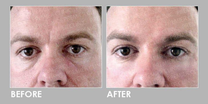 PROFHILO Before After 06 Dr Chen Tai Ho