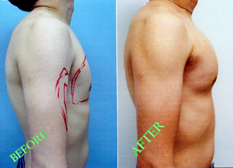 Pectoral Implants Pecs, Men, Photos, Before and After Galleries