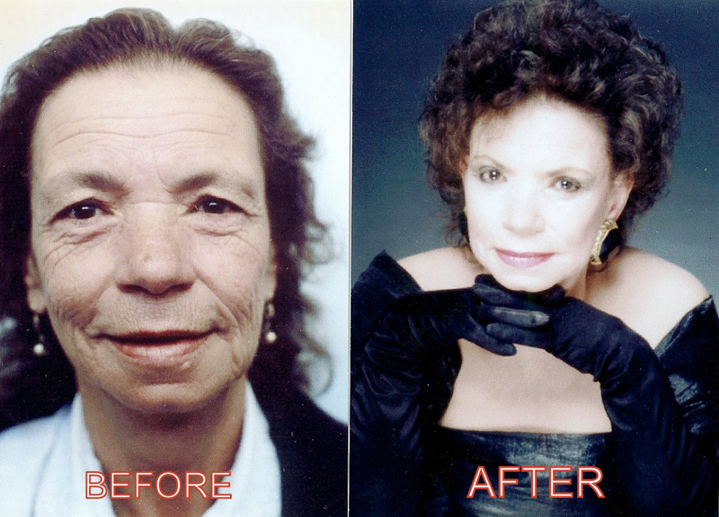 Vertical Facelift Surgery Irvine Long Beach