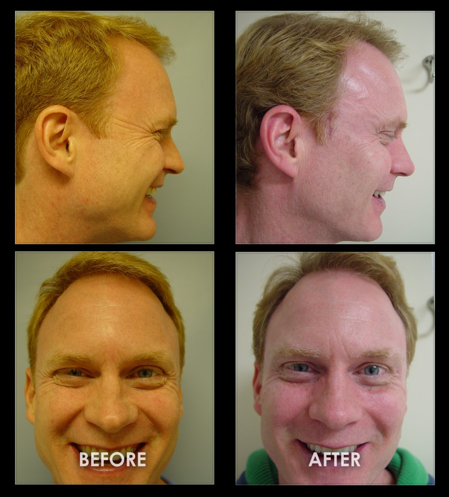 Crows Feet Photos Before and After Galleries Eyelifts Facelift