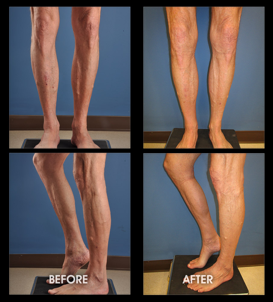 Male and Female Calf Implants Images, Before and After Galleries