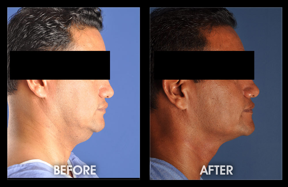 Precision Liposculpture Before and After Galleries