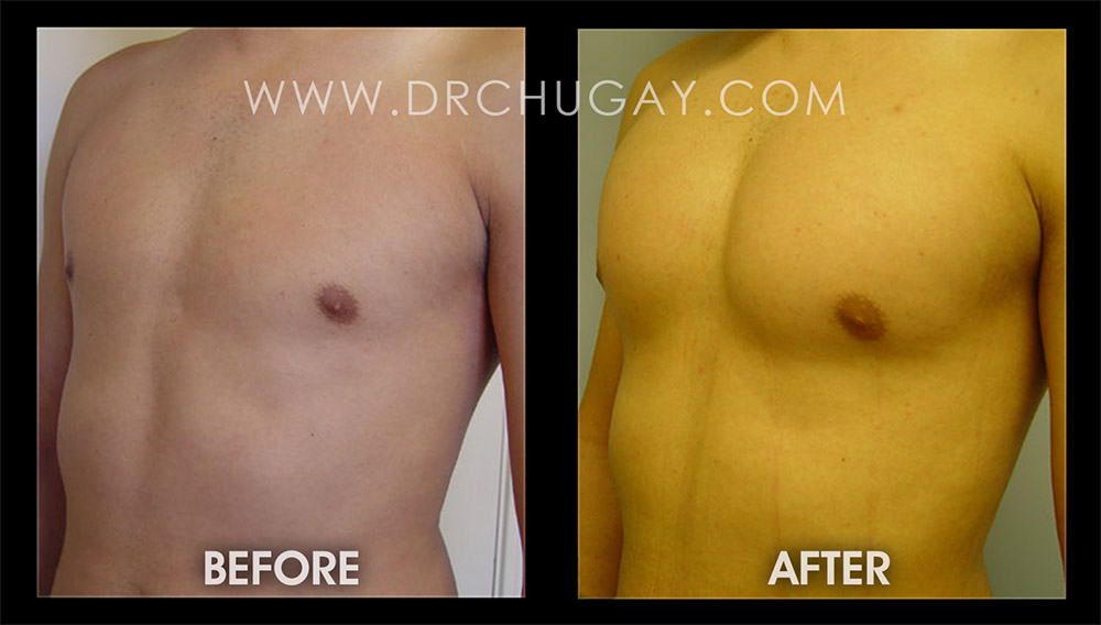 Pectoral Implants