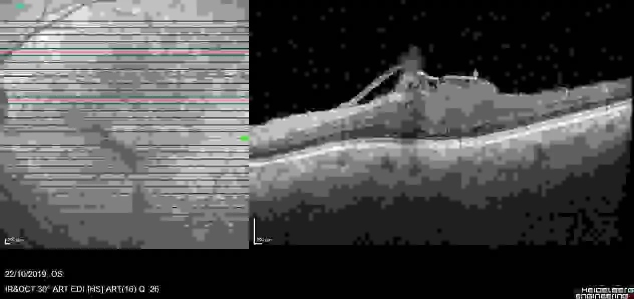 Epiretinal Membrane Guide Symptoms, Surgery, Cost Dr Claudine Pang