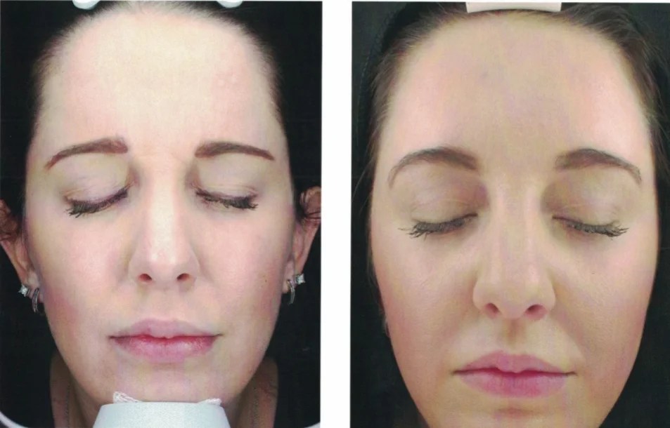 Botox Between Eyebrows Before And After EyebrowShaper