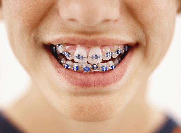 How Much Do Braces Cost? Szymanowski Orthodontics Dr. Damon