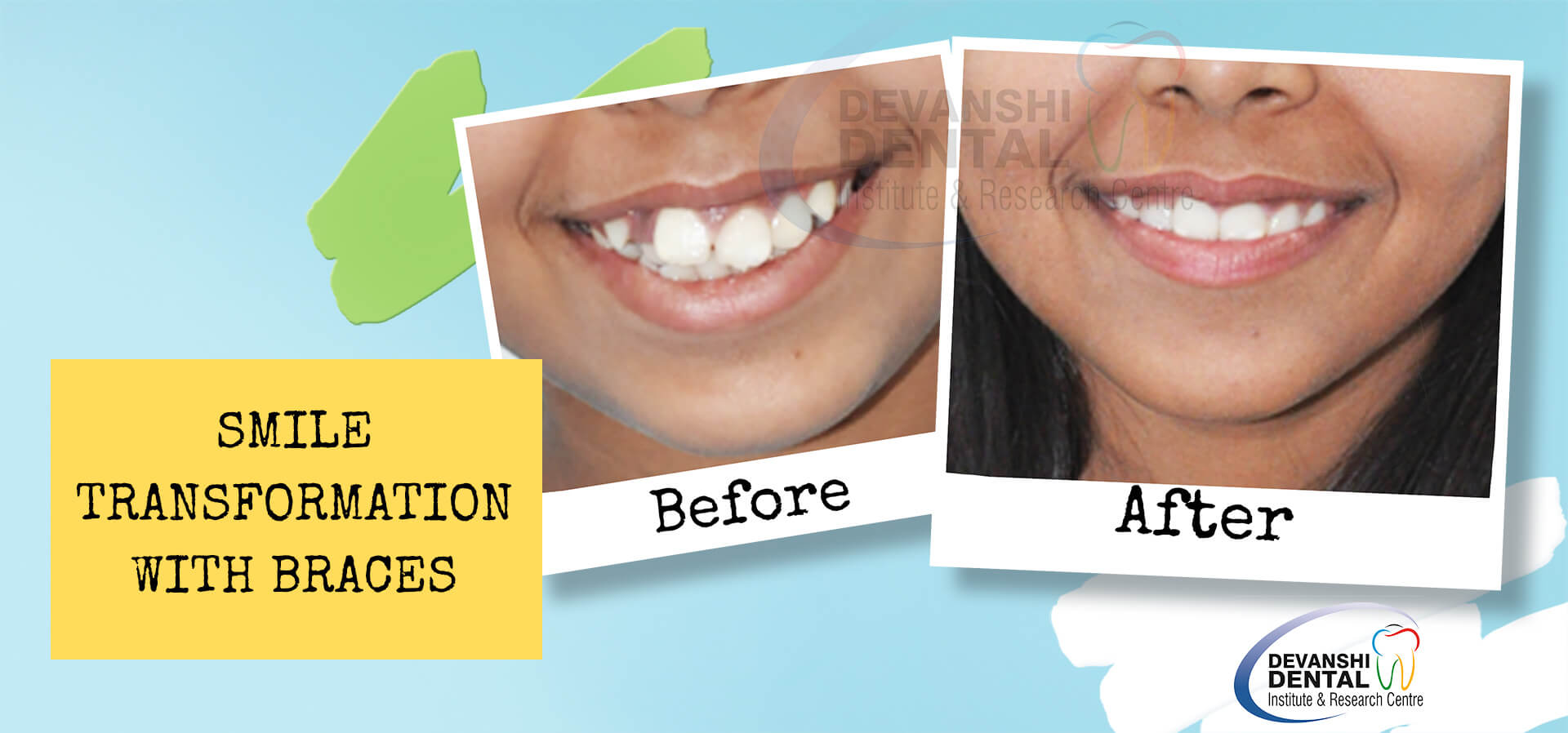 Braces Treatment in Pratap Nagar Sq Zig Zag Teeth Treatment in Pratap