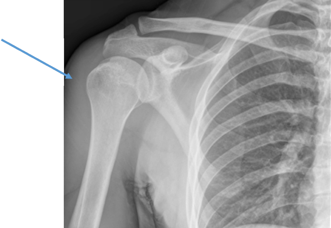 Proximal Humerus Fractures Dr David Duckworth