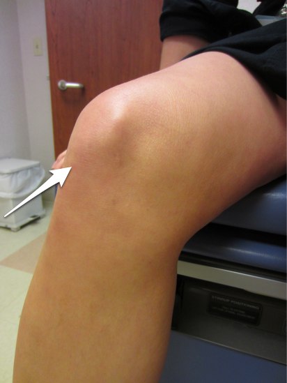 Often there is sudden onset of pain and walking is difficult. How Quickly Do You Need Surgery To Repair A Patellar Tendon Rupture Dr David Geier Sports Medicine Simplified