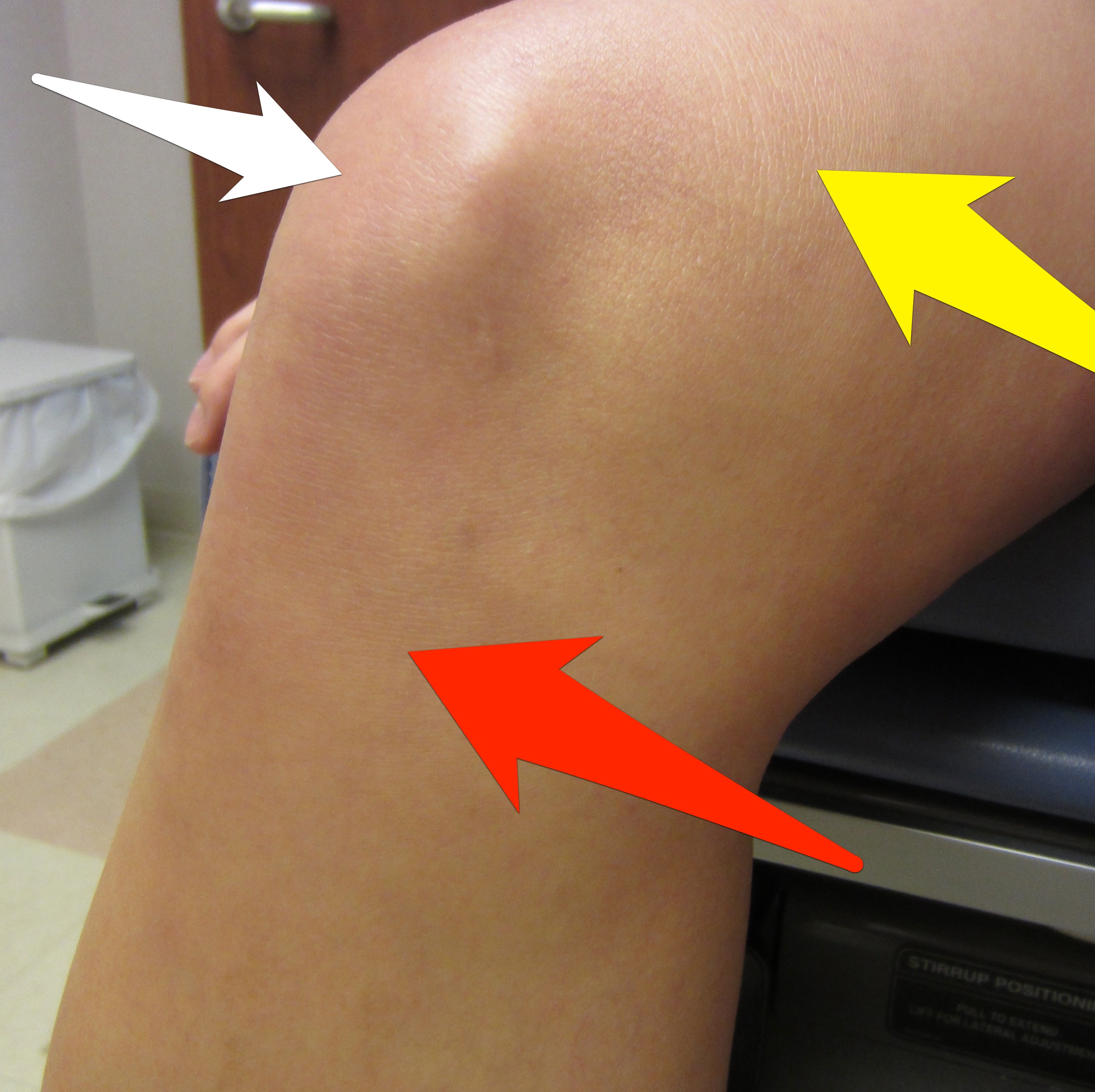 Andrew Bynum's Knee Devastating Possibility of Osteochondritis Dissecans