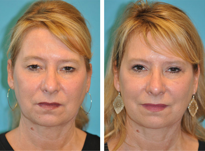 Eyelid Lift Scottsdale, AZ David A. Hecht MD, PC