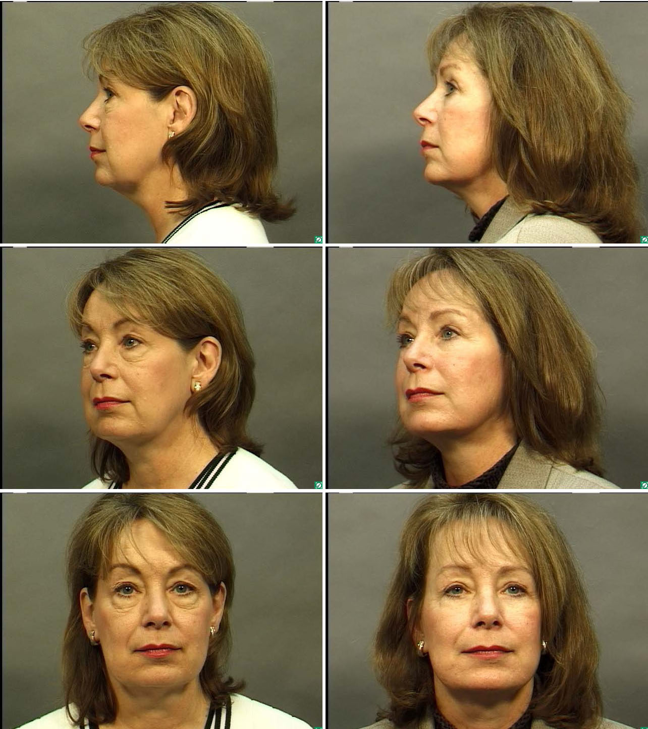 Facelift Before & After Photos by Dallas Plastic Surgeon Dr. Mark Deuber