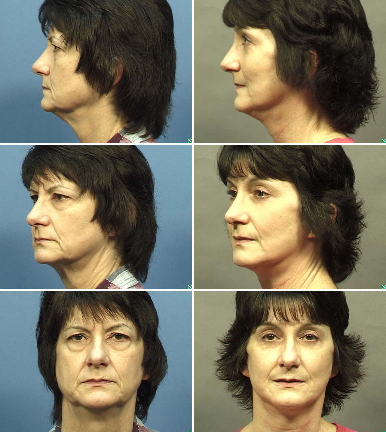 Facelift Before & After Photos by Dallas Plastic Surgeon Dr. Mark Deuber