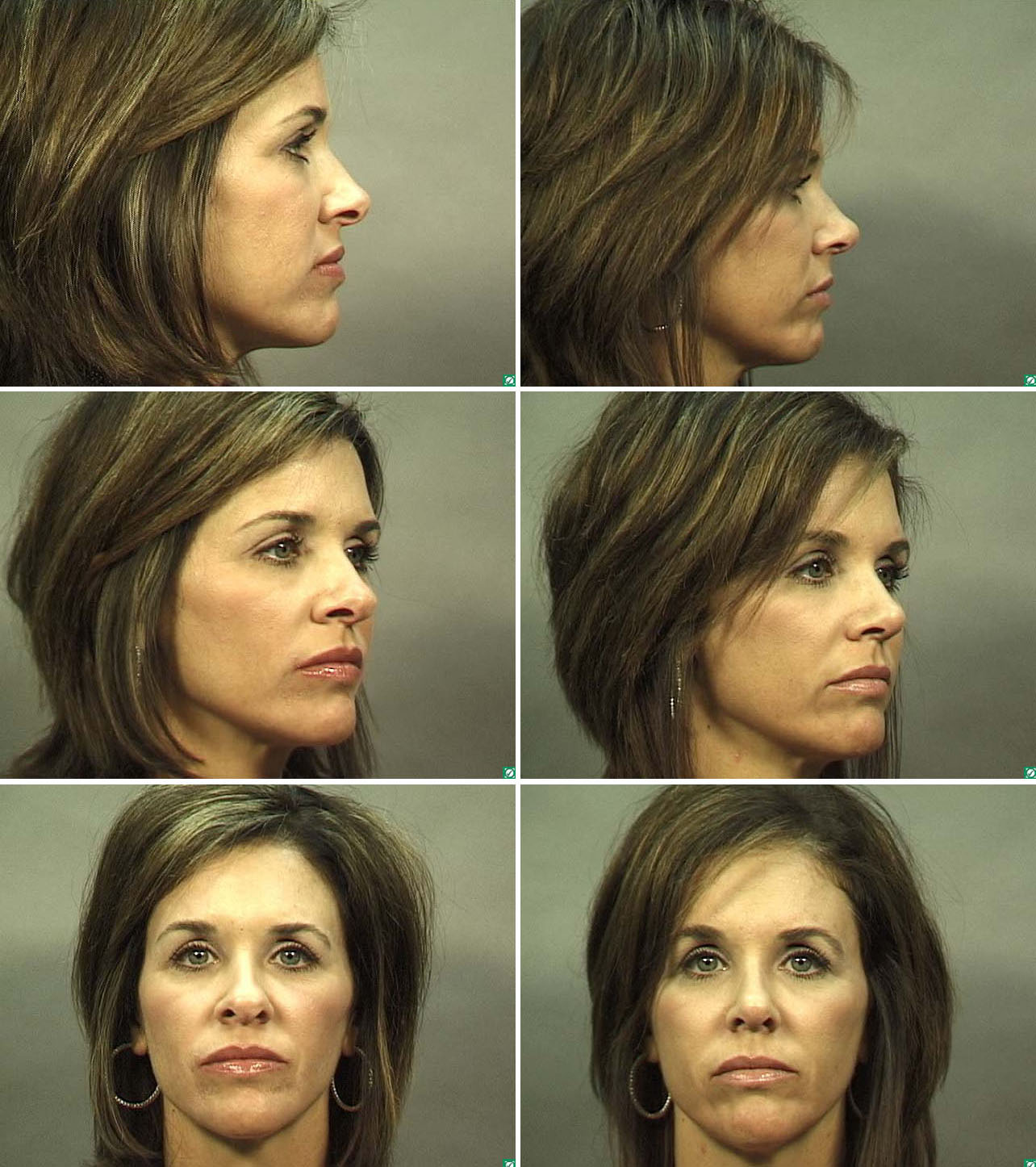 Rhinoplasty (Nose Job) in Dallas Before & After Pictures