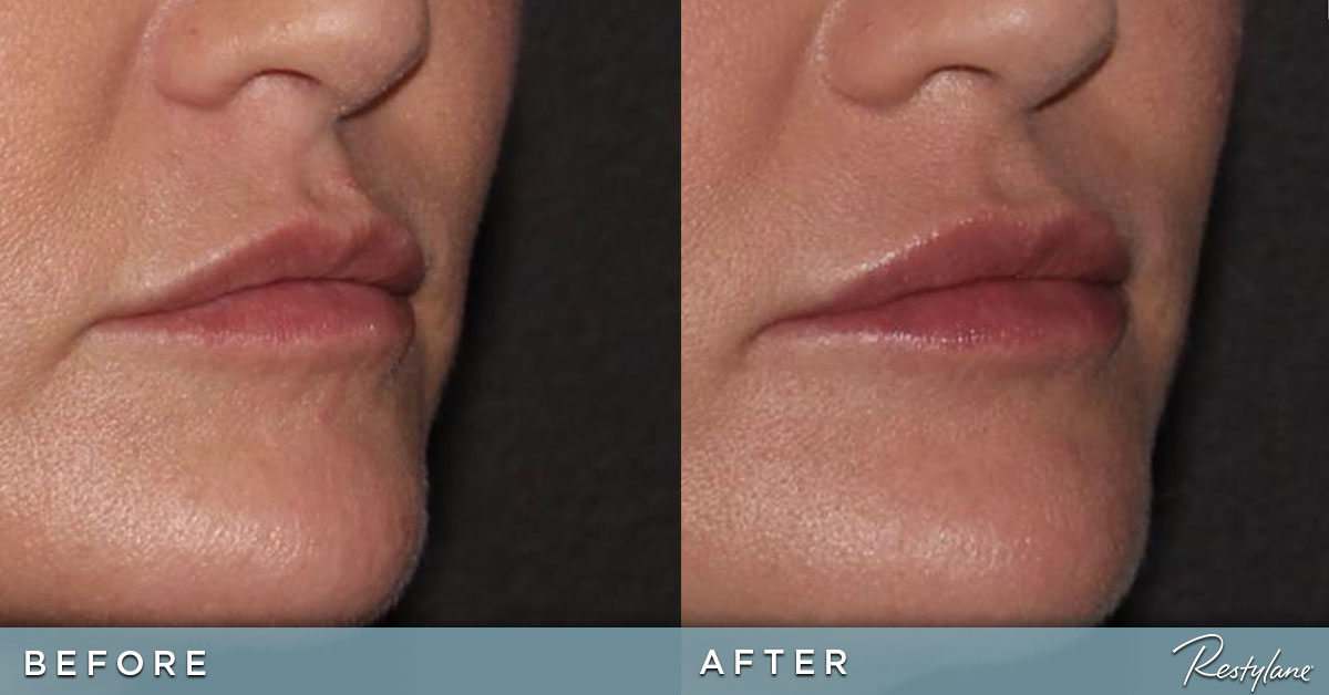 Lip Augmentation Before and After Photos Juvederm