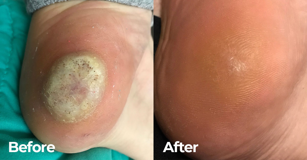 Swift Wart Treatment Plantar Wart Removal Wart Treatment