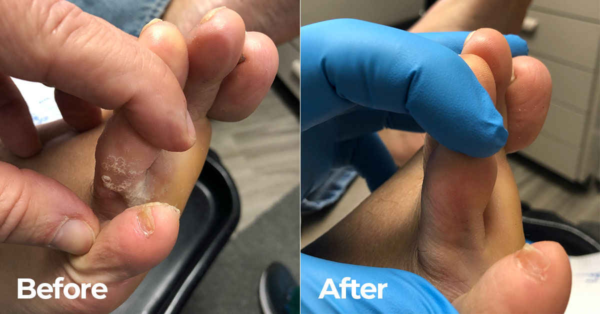 Swift Wart Treatment Plantar Wart Removal Wart Treatment