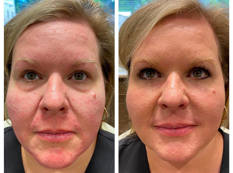 Tear Trough Correction What To Expect With Under Eye Filler