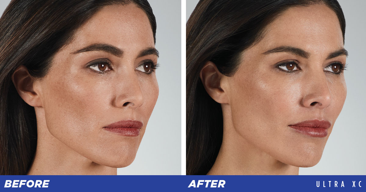 Lip Augmentation Before and After Photos Juvederm